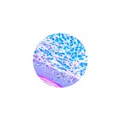 Combined Eosinophil-Mast